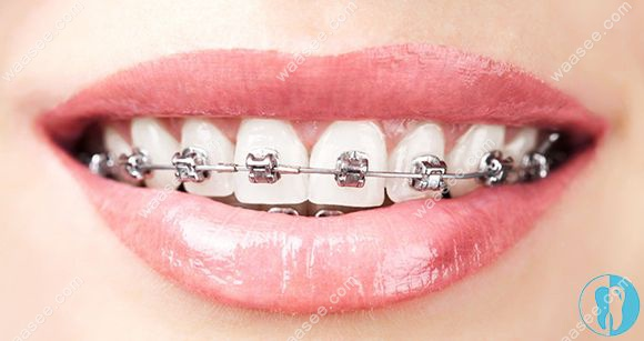 What's the method for the teeth