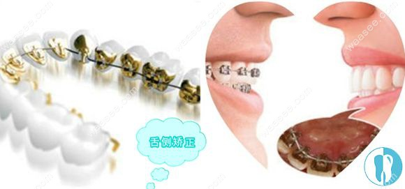 What's the method for the teeth