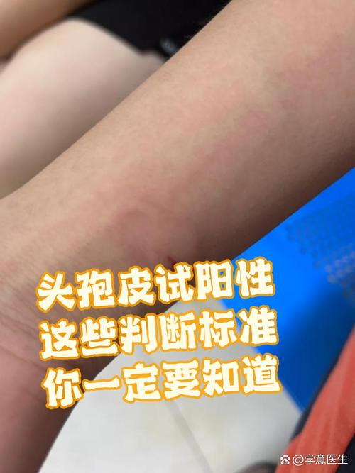 1.0头孢皮试的配制方法