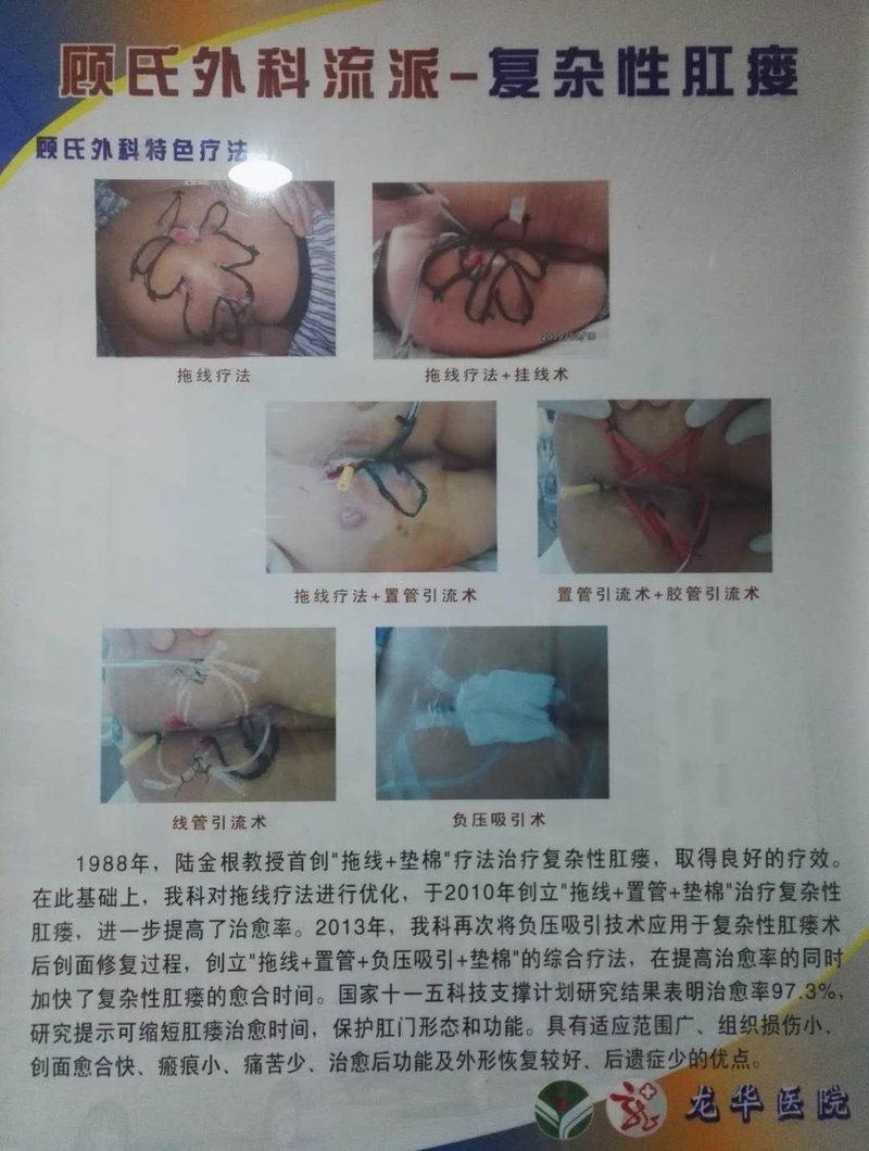 Anal fistula treatment