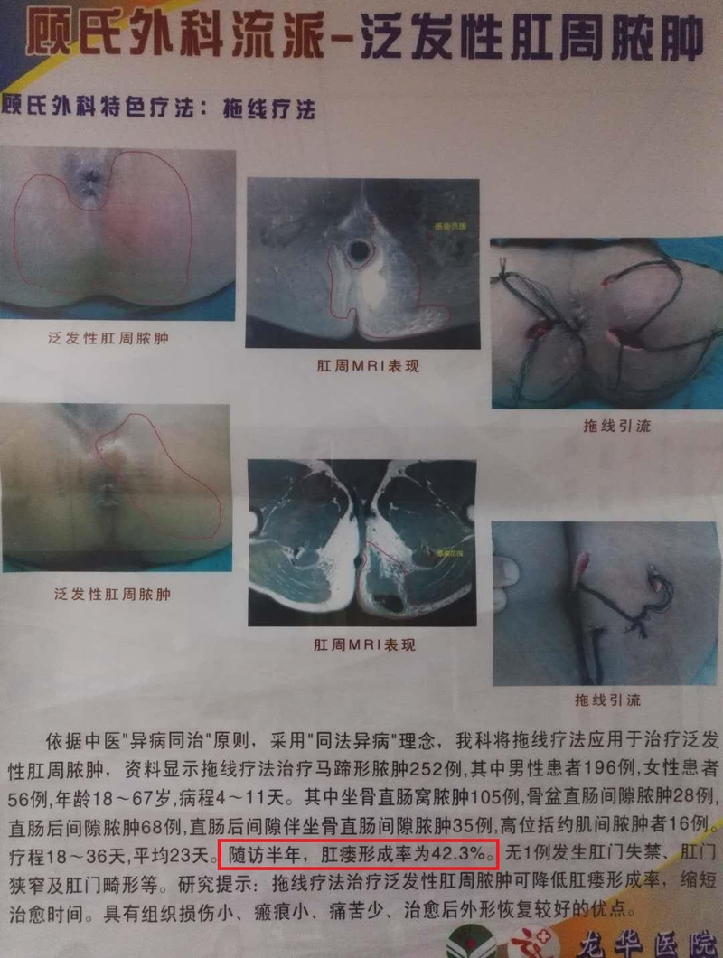Anal fistula treatment