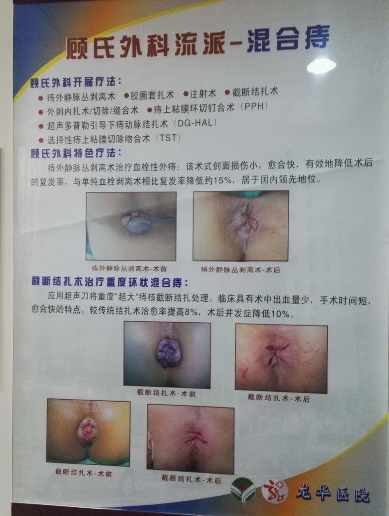 Anal fistula treatment