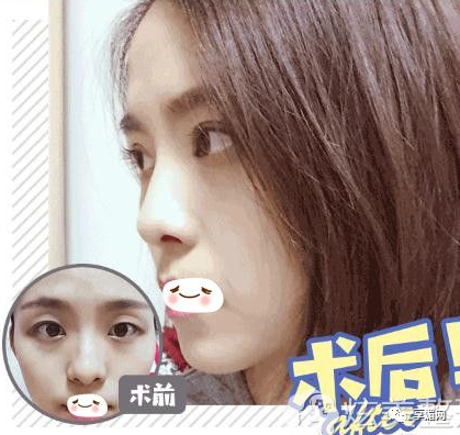 韩式隆鼻价格美莱定点