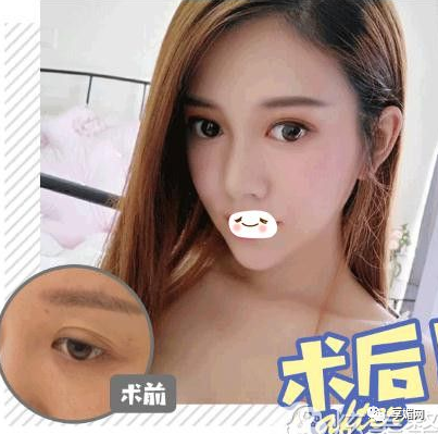 韩式隆鼻价格美莱定点