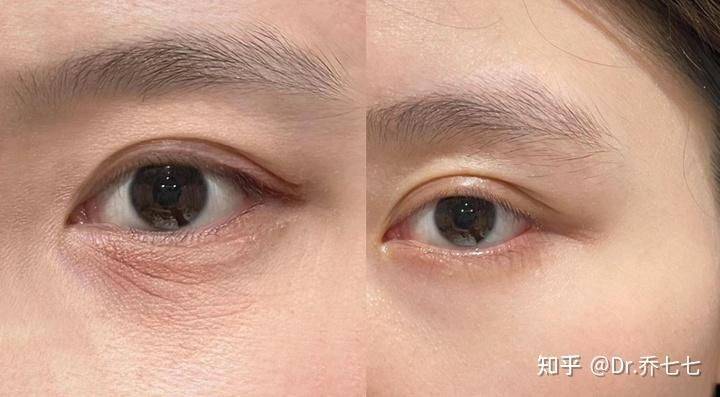 雅诗兰黛 眼霜价格