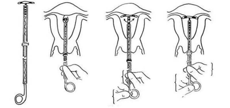 Intrauterine devices, the principles of the ring