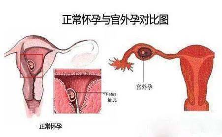 Intrauterine devices, the principles of the ring
