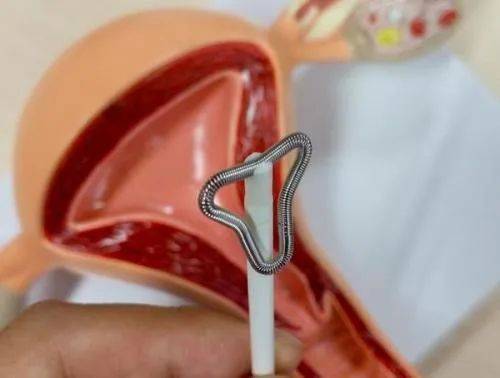 Intrauterine devices, the principles of the ring