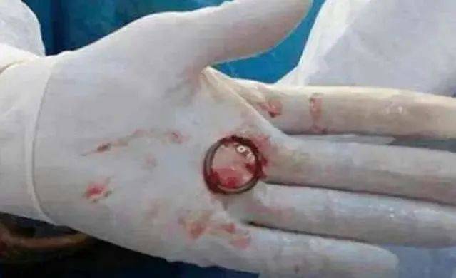 Intrauterine devices, the principles of the ring