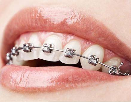 The principle of dental correction
