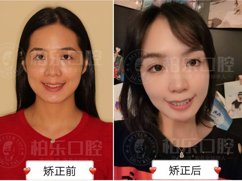 The principle of dental correction