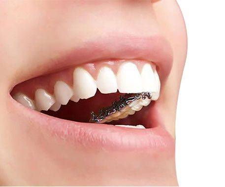 The principle of dental correction