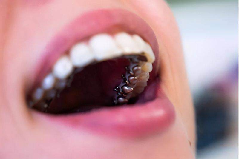 The principle of dental correction