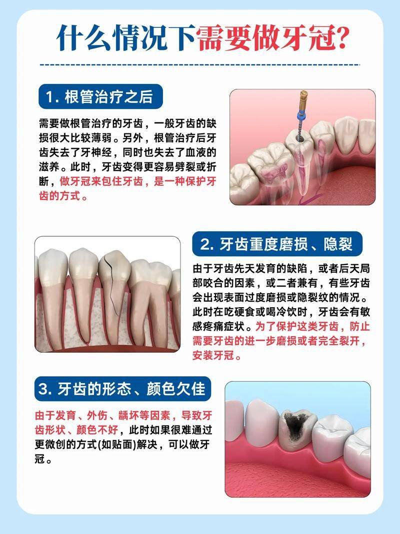 After the root tube treatment, you take the tooth crown