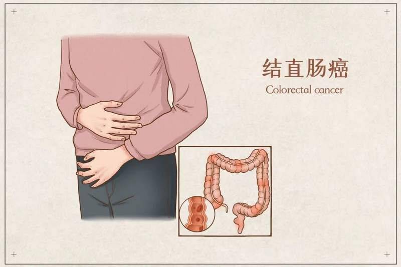 Cost of rectal cancer treatment