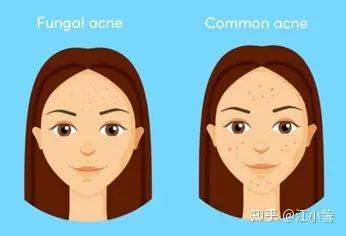 祛痘激光一次多少钱