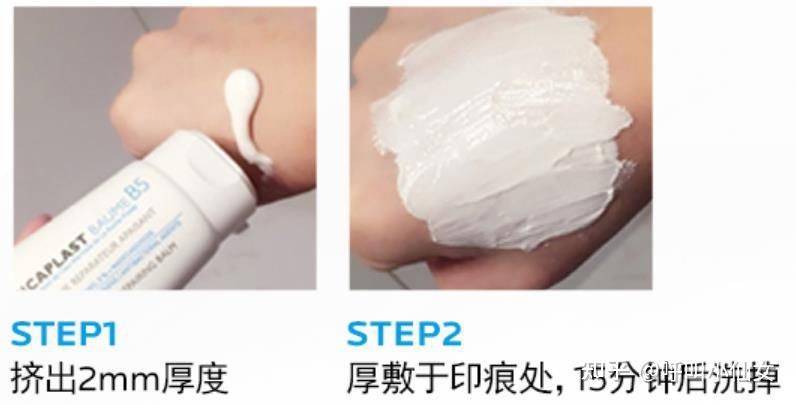 祛痘激光一次多少钱