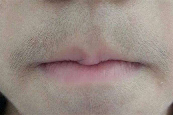 10岁女孩“胡须”浓密，这几种零食家长要控制，否则对孩子没好处