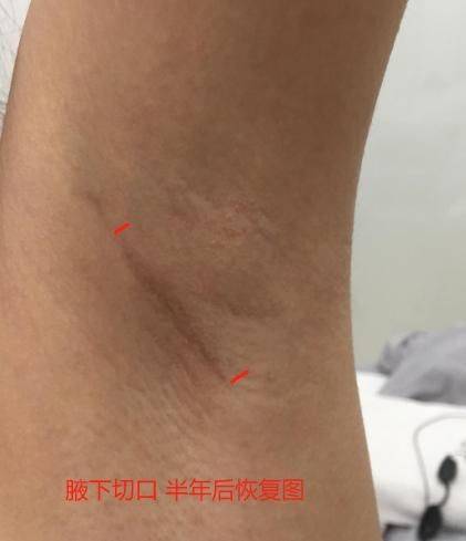 乳晕缩小整形多少钱