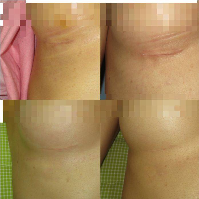 乳晕缩小整形多少钱