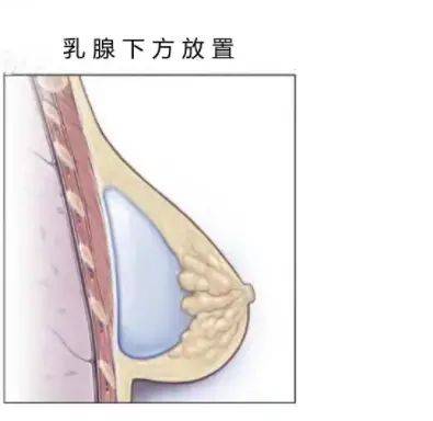 乳晕缩小整形多少钱