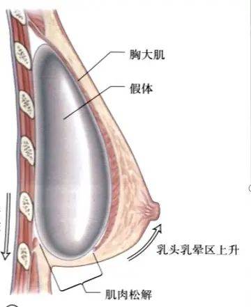 乳晕缩小整形多少钱
