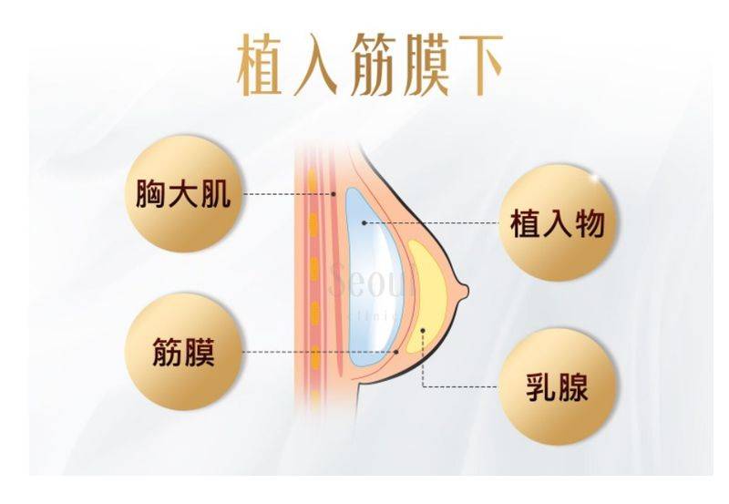 乳晕缩小整形多少钱