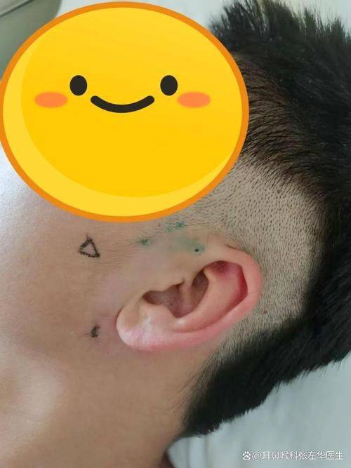 How much for fistula surgery