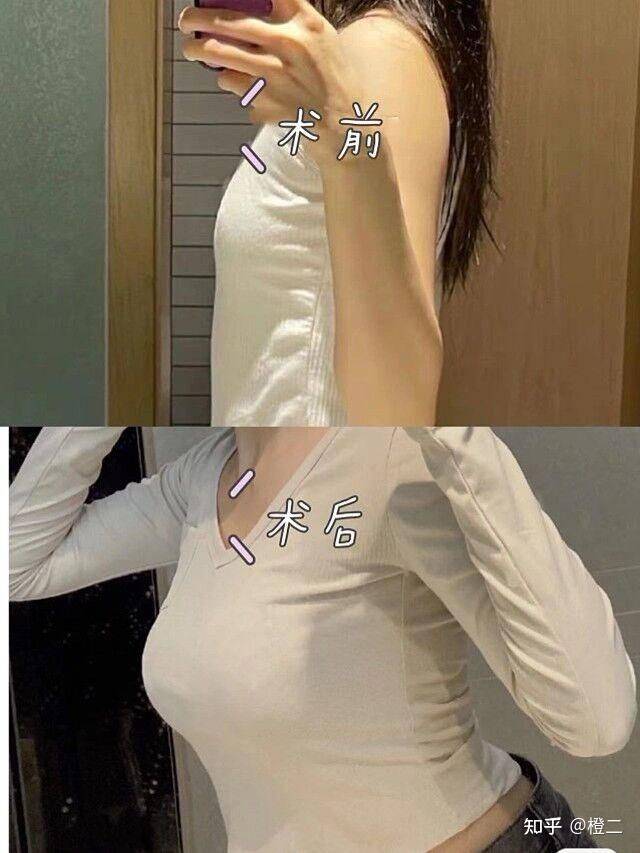 乳晕缩小整形多少钱