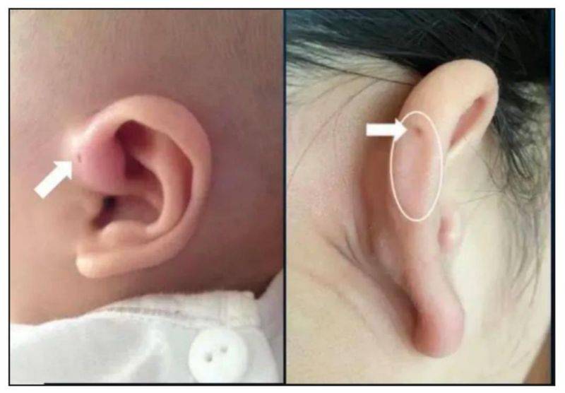 瘘管手术多少钱