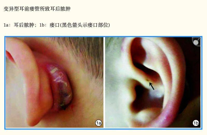 瘘管手术多少钱