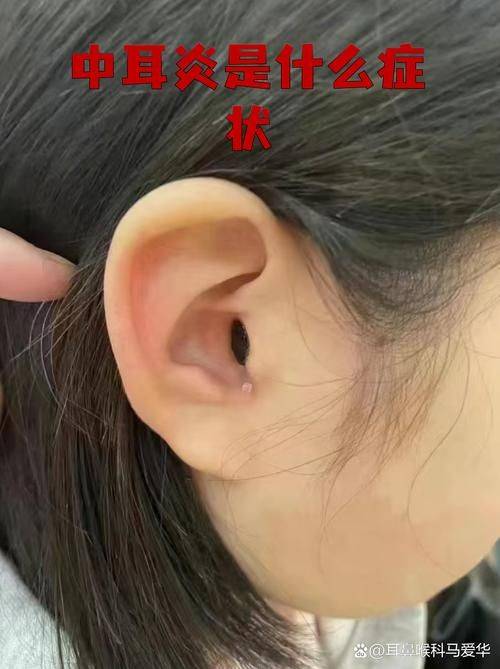 瘘管手术多少钱