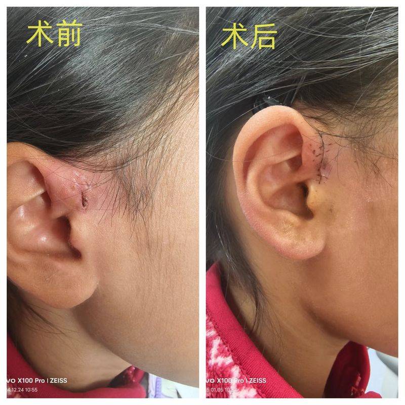 How much for fistula surgery