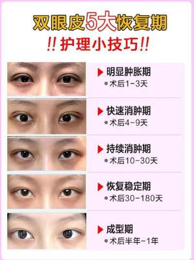 北京做双眼皮多少钱