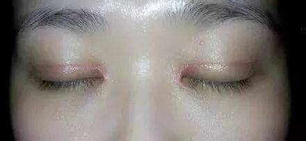 上海缝线双眼皮多少钱