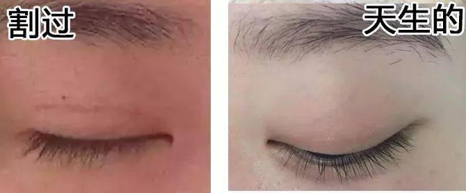 上海缝线双眼皮多少钱