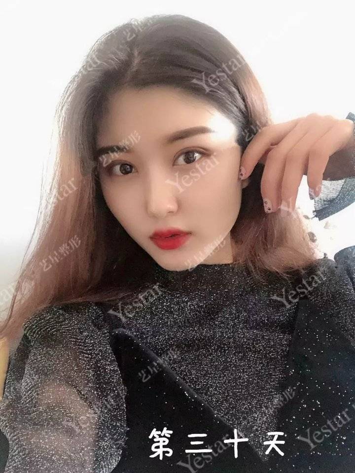 上海缝线双眼皮多少钱