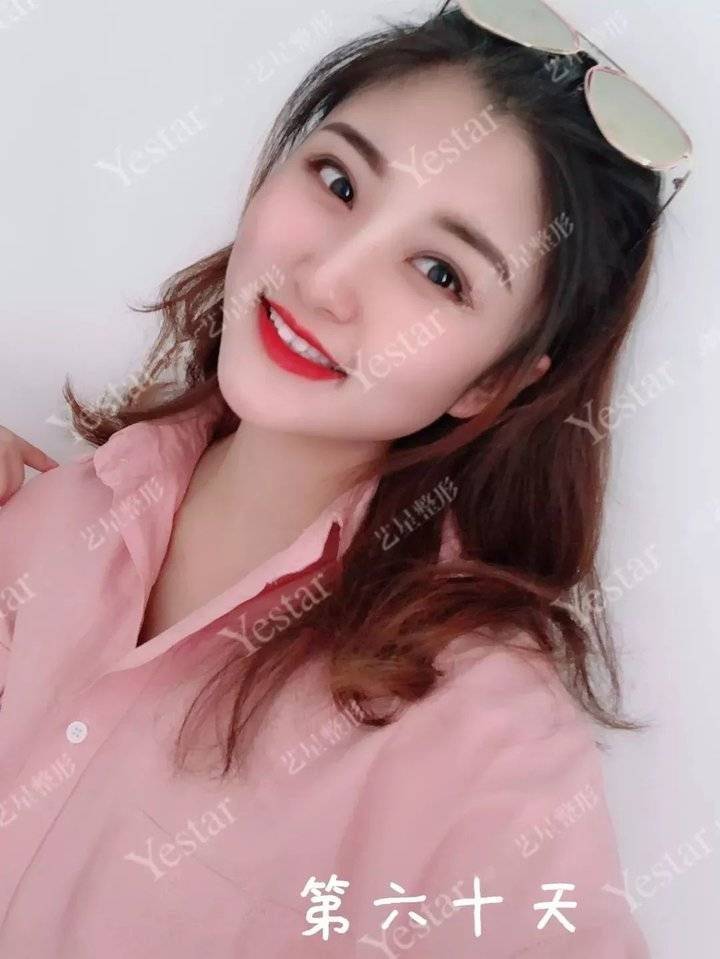 上海缝线双眼皮多少钱