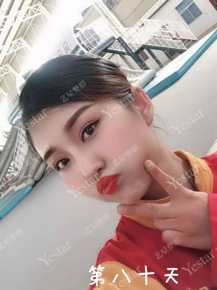 上海缝线双眼皮多少钱