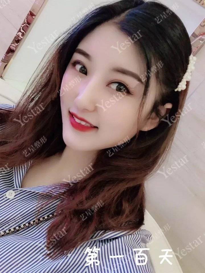 上海缝线双眼皮多少钱