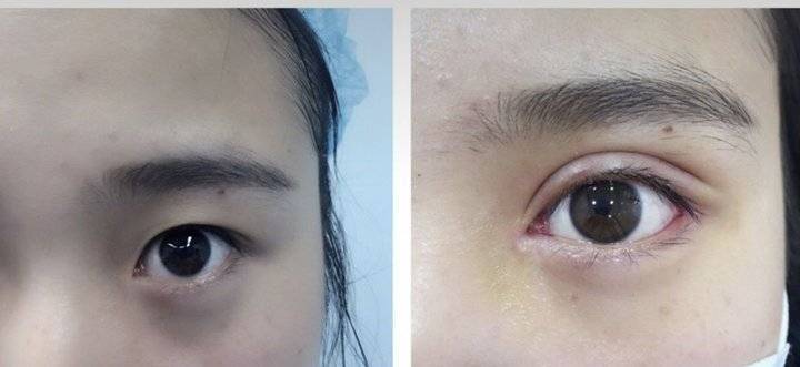 上海缝线双眼皮多少钱