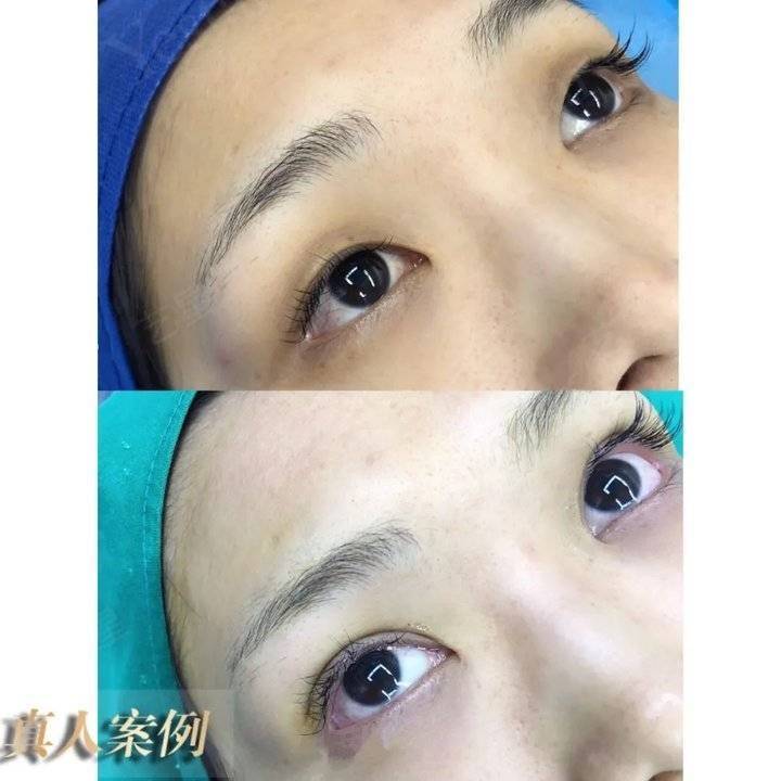 上海缝线双眼皮多少钱