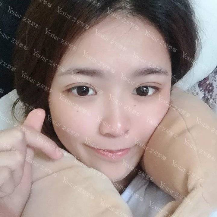 上海缝线双眼皮多少钱