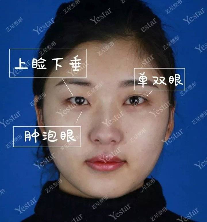 上海缝线双眼皮多少钱