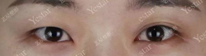 上海缝线双眼皮多少钱