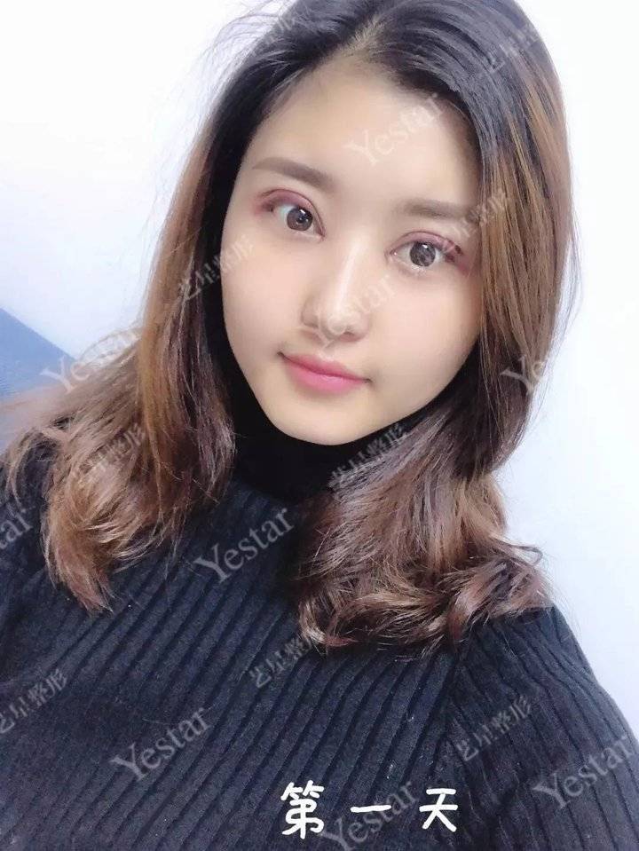 上海缝线双眼皮多少钱