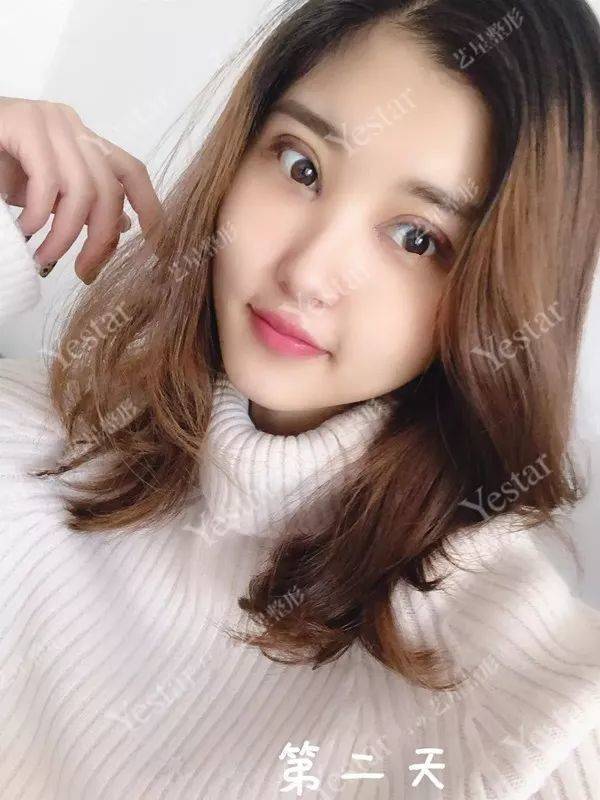 上海缝线双眼皮多少钱