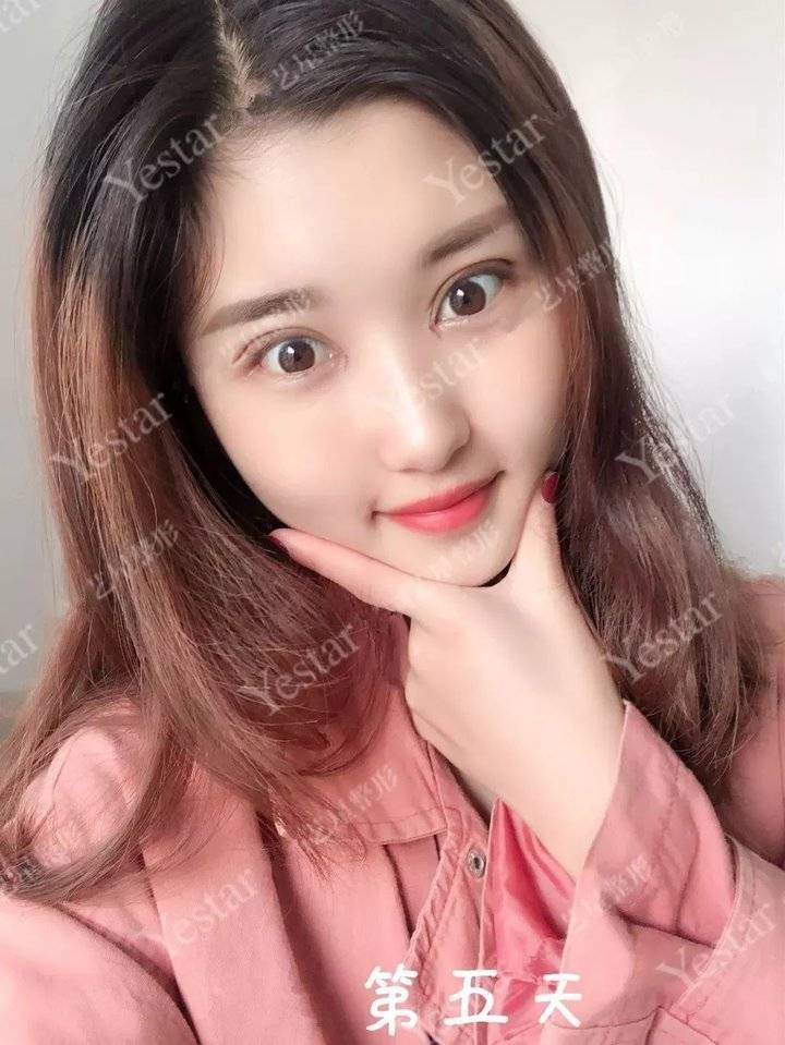 上海缝线双眼皮多少钱