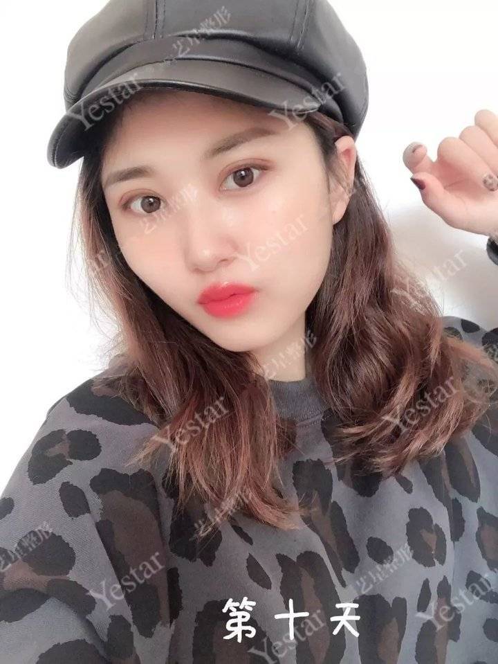 上海缝线双眼皮多少钱