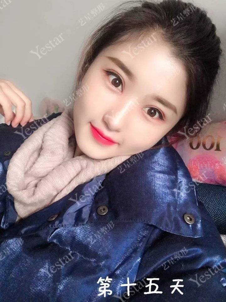 上海缝线双眼皮多少钱